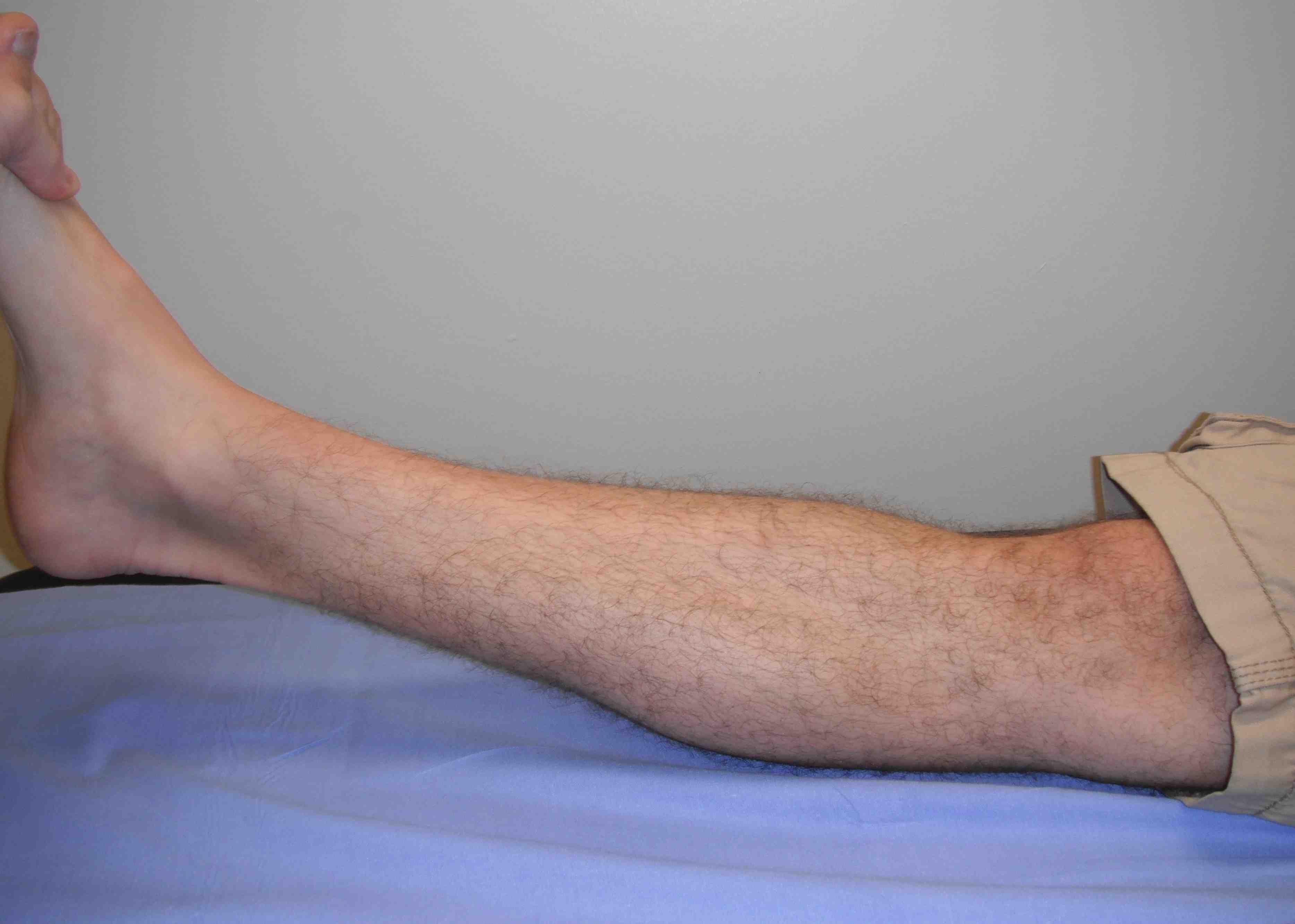 Ligamentous Laxity Knee Hyperextension